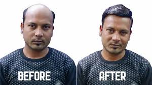 Hair Wigs for Human : गंजेपन से हर कोई परेशान है, हेयर पैच से दूर करें अपनी समस्‍या.